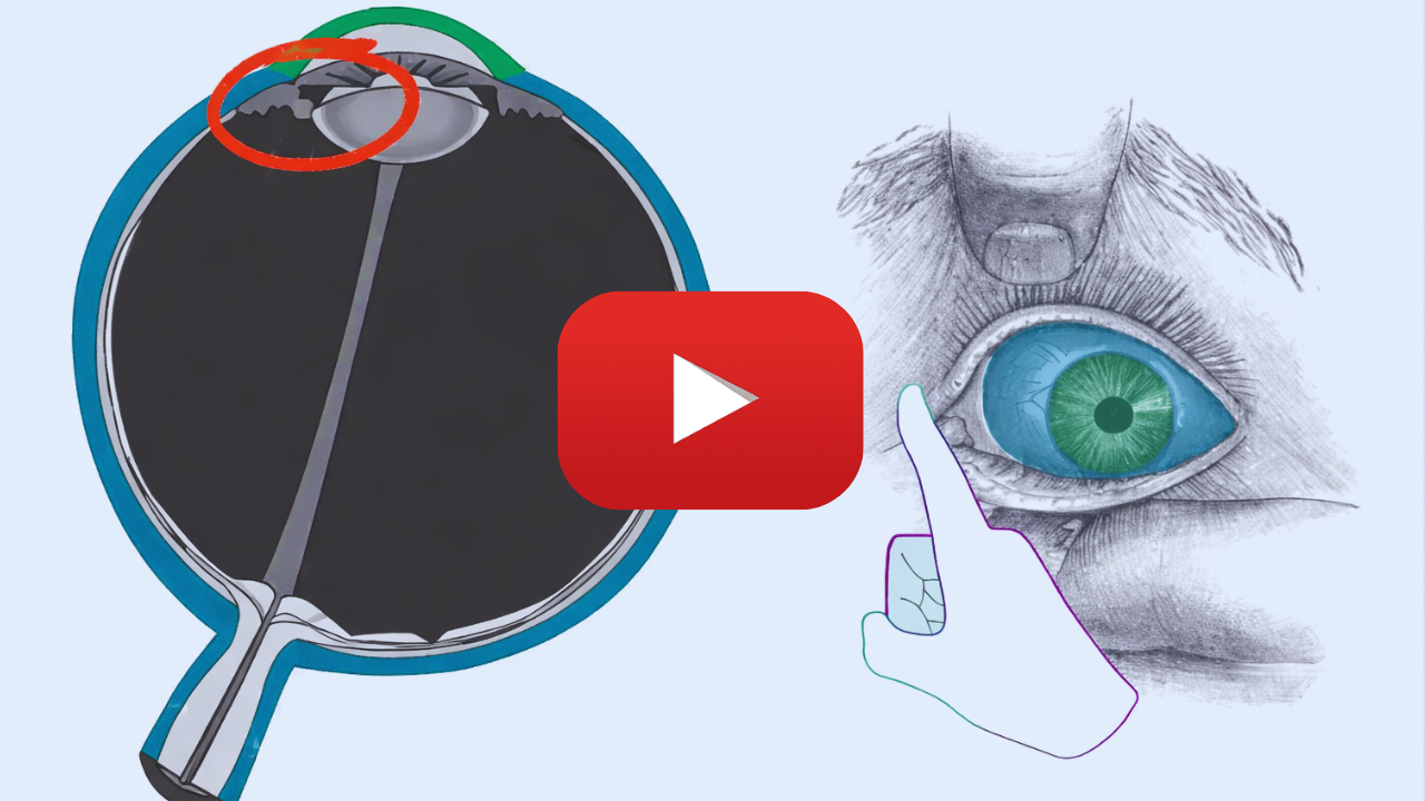 Harvard study eye floaters
